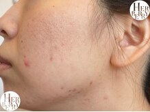 ハーバリー ハーブピーリング 岐阜(HERBERRYハーブピーリング)/ハーブピーリング専門店HERBERRY