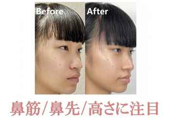 ラプリ 浜松店(Raplit)/隆鼻＋輪郭矯正40分20回
