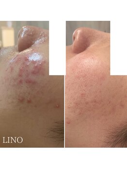 リノ(Lino)/いつからでもお肌は変われる