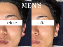 メンズOK!1回の施術で効果実感♪清潔感&イケメン度アップ↑