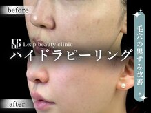 リープ(Leap)/ハイドラピーリング