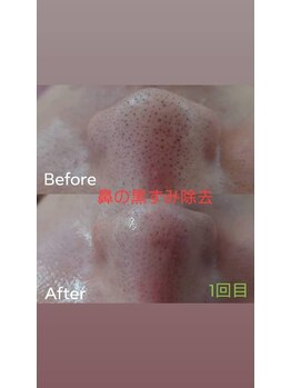 サロンエム(Salon m)/毛穴