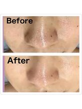 フィオーレ/☆毛穴洗浄マシン導入♪