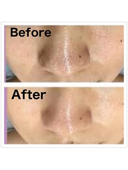 フィオーレ/☆毛穴洗浄マシン導入♪