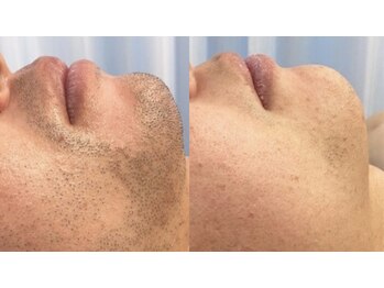 ラクーン(RACCOON)/