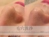 【毛穴洗浄】水素で汚れごっそり◎ハイドロスプラッシュ　¥12000→