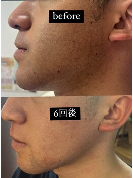 ヴィーナス(Venus)/髭脱毛 6回後