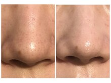 カナエル(QANAEL)/【毛穴洗浄の流れ】