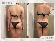 エステティックサロン ラ ベルタ(Esthetic Salon La Belta)/セルライトゼロ５回