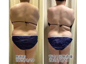 クールスパ(COOL SPA)/背中1回でスッキリ