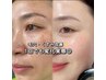 【肌質改善】毛穴・ニキビ・くすみ改善のハイバー※RE:Z肌管理70分 ¥16,800