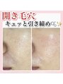 ホワイトアクア 甲府店(WHITEAQUA) 毛穴ケア得意です!