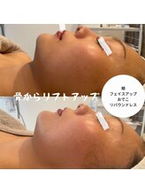 エミナル(EMINALu)/結果☆CHINOTHEMETHOD　FACE