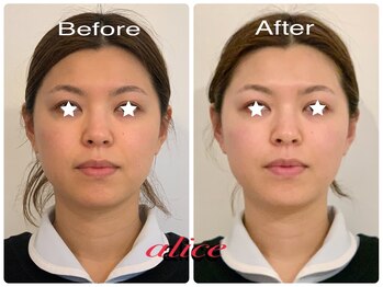 アリス(alice)/30代お客様ビフォーアフター