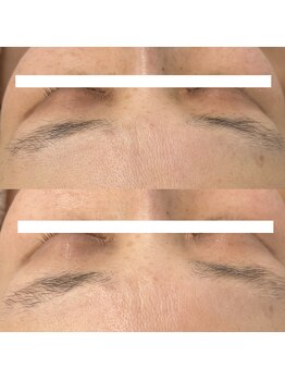 ヴェルシック(Belchic)/瞼の色素の沈着も根本から改善