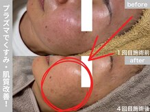 サロン ビュー(salon view)/40代女性〈くすみ悩み〉　