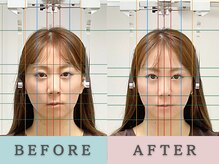 エルシンメトリー矯正院(ailesシンメトリー矯正院)/before＆after　ailes式小顔矯正