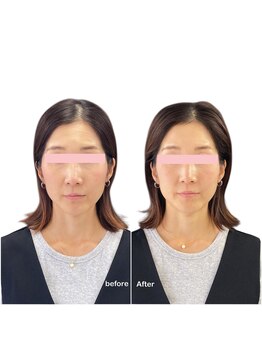 ニコディア(nico-dia)/美容鍼