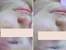 エステティックサロン アールグレー 名古屋駅店/フェイシャルメニュー10種類以上