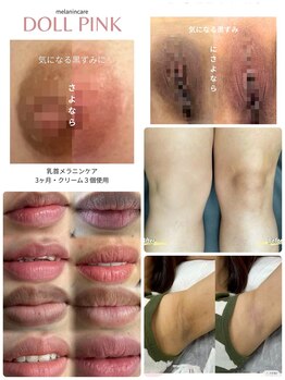 エステリア 蒲田の写真/今話題の黒ずみケアが出来るサロン。産後などで黒ずんだお肌を元の自然なピンク色に♪