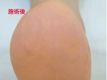 レフス 北参道店(REFUSS)/本格角質ケア