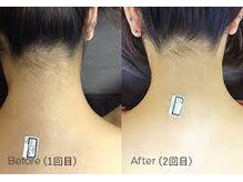 サロンドベルエコア(SALON DE BELLECOA)/うなじ脱毛