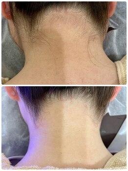 ラカ 長野駅前本店(LaKa)/脱毛イメージ（うなじ）