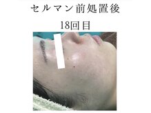 ヴィヴ 熊本(ViV)/【セルマンピーリング】after