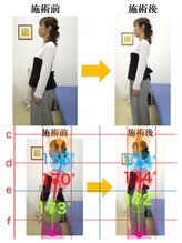 やぎはし整体院 篠籠田店/AI分析：姿勢ビフォーアフター