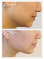 カピリナスパ(Ka.Pilina Spa) ALLハンド リフトUP