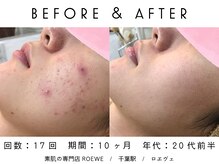 ロエヴェ(ROEWE)/ニキビ改善・毛穴ケア・肌質改善