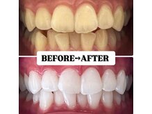 ホワイトニングサロン 豊中/Before&After美白ホワイトニング