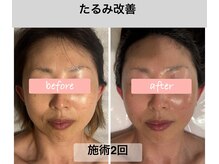 ミピマム 横浜駅前店/たるみ改善 お客様beforeafter