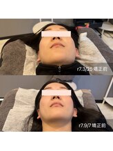 プライミー(PRIMY)/首の歪み