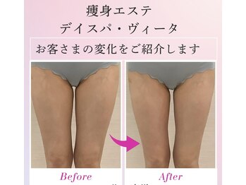 デイスパ ヴィータの写真/【ヒップ、太もも、ふくらはぎ】コンプレックスの塊の下半身を変える！私の脚でも細くなれるんだ！驚き！