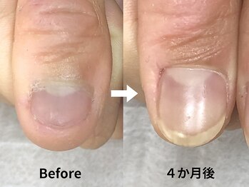 エルナの写真/深爪矯正特化サロン♪お客様に合わせたアドバイスで、美しく健康的な自爪育成を応援します！