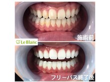 ルブラン 奈良店(Le Blanc)/白い歯は清潔感溢れます！