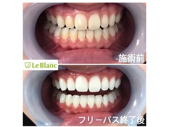 ルブラン 奈良店(Le Blanc)/白い歯は清潔感溢れます!