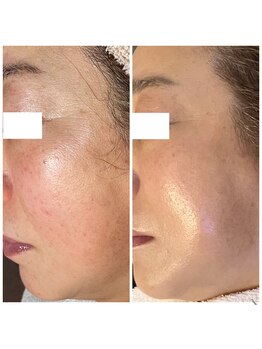 アンド ユー(and.yu)/シミケア・美肌コース1回