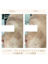 スリース(threes)/シミケア