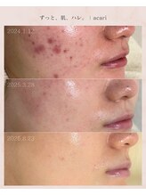アカリ(acari)/お客様のニキビケア変化