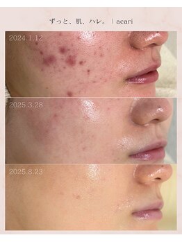 アカリ(acari)/お客様のニキビケア変化