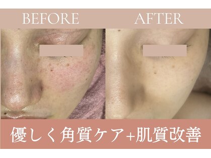 エピル(EPIL)の写真