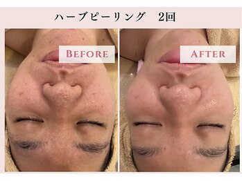 レクラ バイ ドクターエイチ(L'ECLAT by Doctor.H)/ハーブピーリング