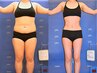 【痩身初めての方】痩身人気No.1全身脂肪撃退サイズダウン"特許"痩身コース