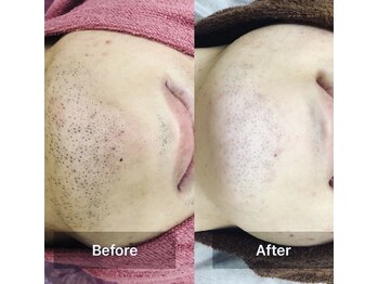 サロン シェリミー(Cheri mi)/男性美肌ヒゲ脱毛