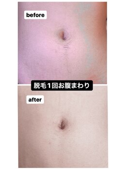 ルルン(LuLuN)/お腹まわり脱毛