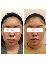 ウル 下北沢(Ulu)/頭蓋骨小顔矯正4回