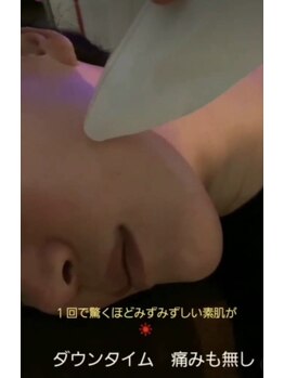 クピド(Cupid)/刺さない水光ジェット