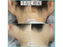 アクト クロ(ACT curro)/【うなじ襟足】脱毛施術例